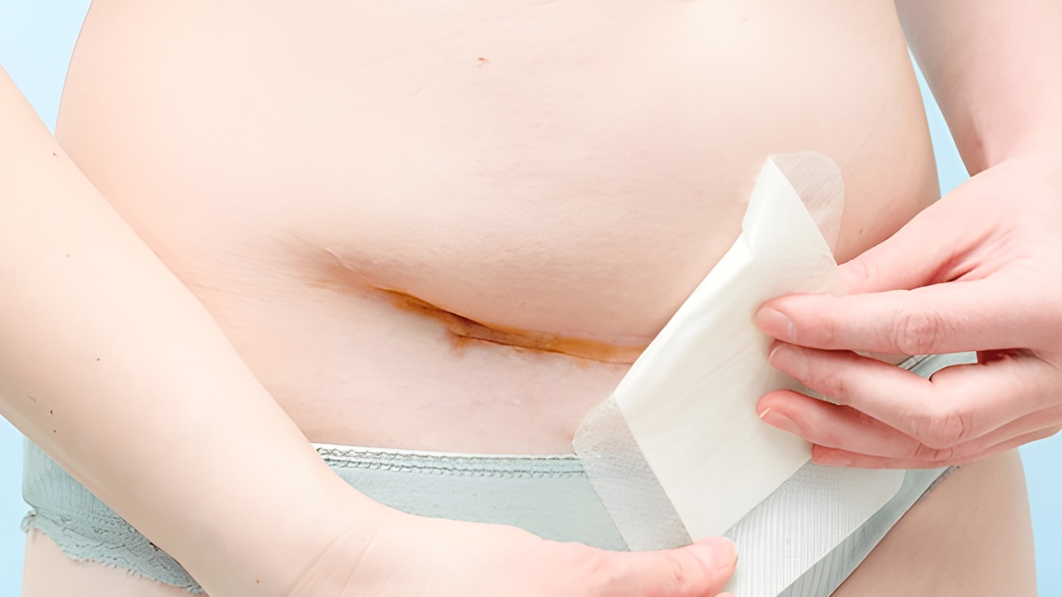 क्या छींकने से C-Section के टांके खुल सकते हैं? डॉक्टर से जानें 
