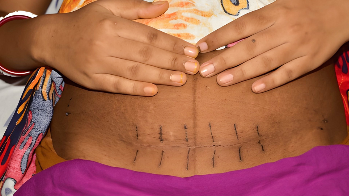 How to protect C-section stitches from sneezing