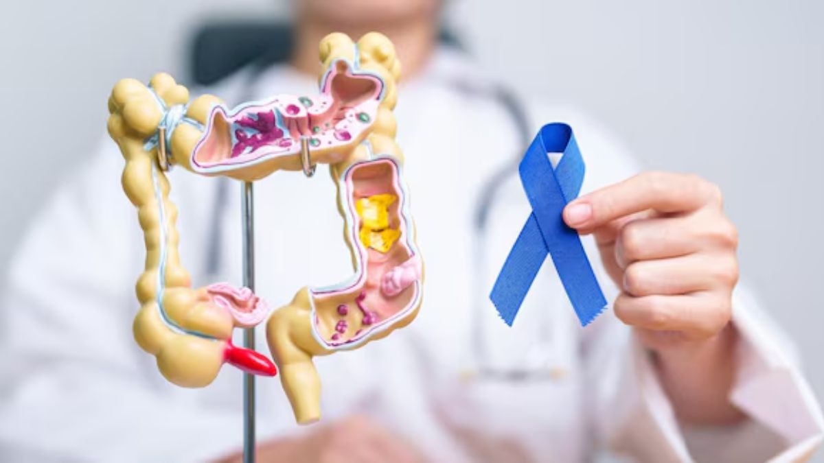 colon cancer