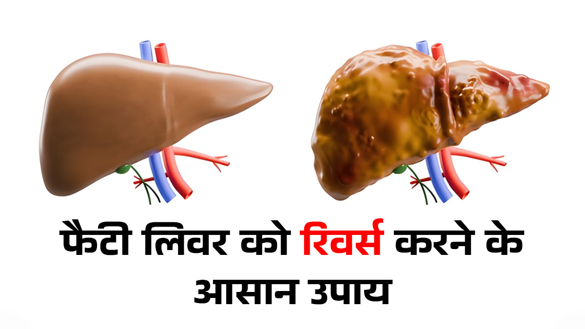 लिवर पर जमी फैट की परत हटेगी जल्दी, डाइटिशियन बता रही हैं 4 कारगर उपाय