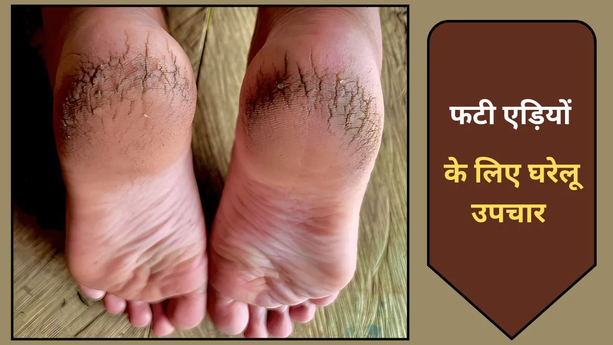 gharelu nuskha for cracked heels