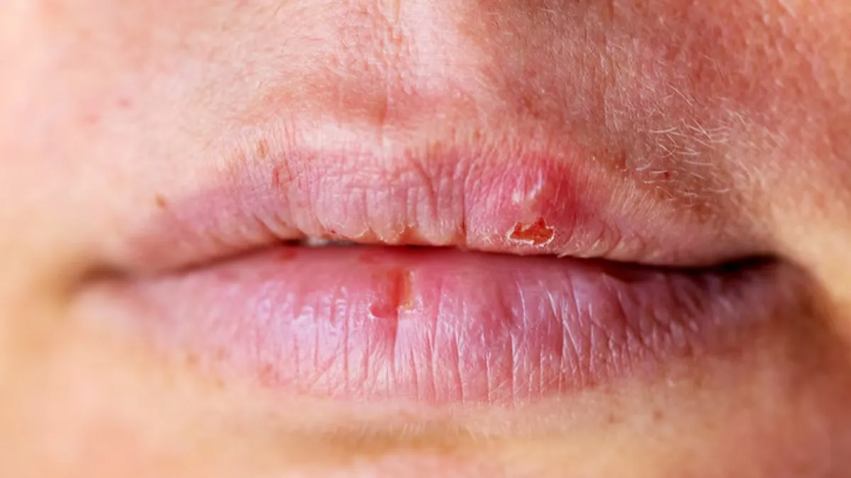 how to treat chapped lips naturally