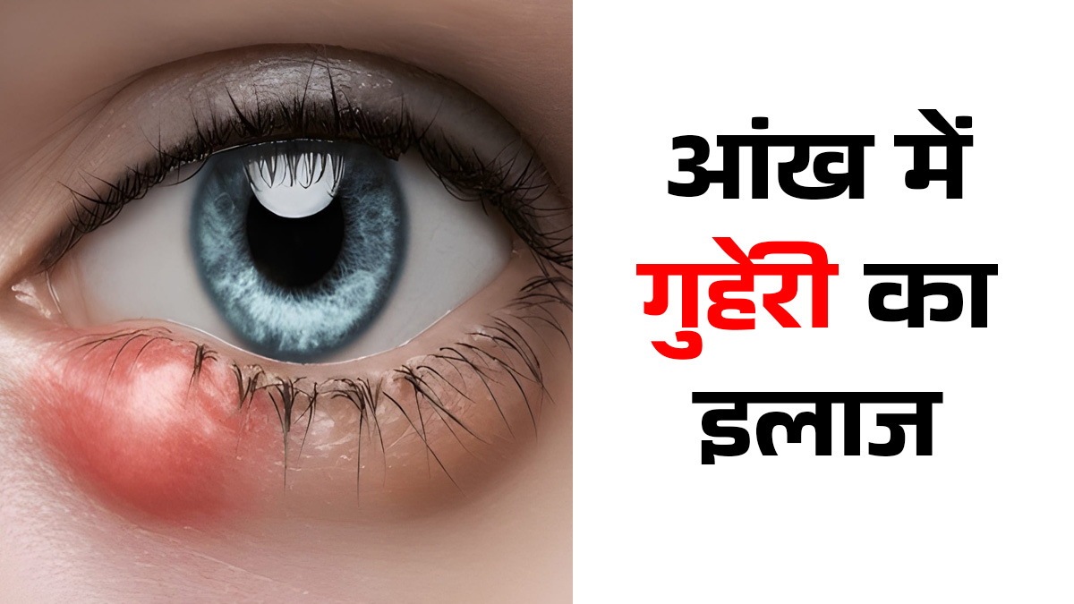 आंख में गुहेरी होने पर क्या करें? तुरंत राहत के लिए डॉक्टर के आसान उपाय आजमाएं