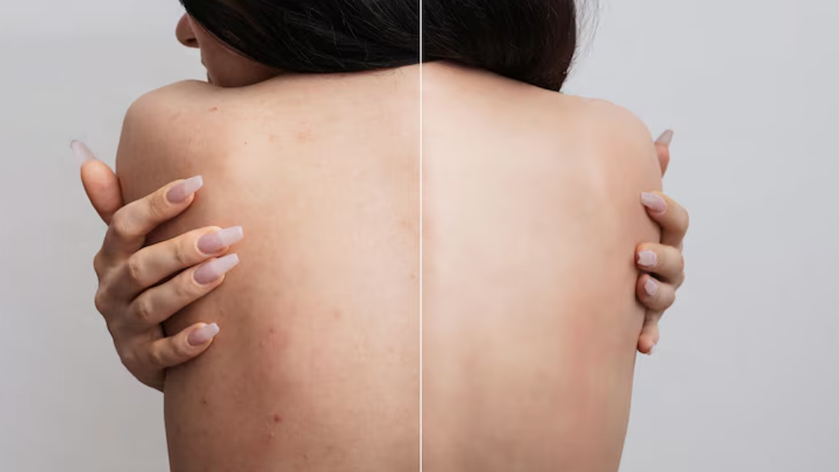 Back Acne Solution: पीठ के मुंहासों से राहत दिलाएगा ये खास होममेड पेस्ट, एक्सपर्ट से जानें बनाने का आसान तरीका