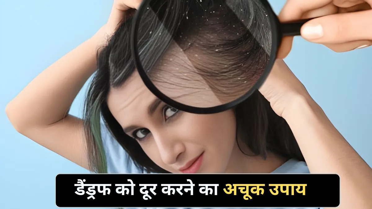 dandruff treatment at home
