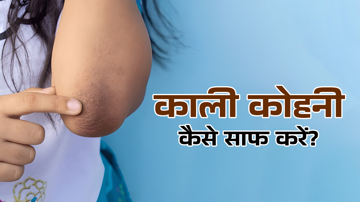 Dark Elbows: काली कोहनी को चमकदार बनाने के लिए आजमाएं ये 2 घरेलू नुस्खे, आप भी करें ट्राई