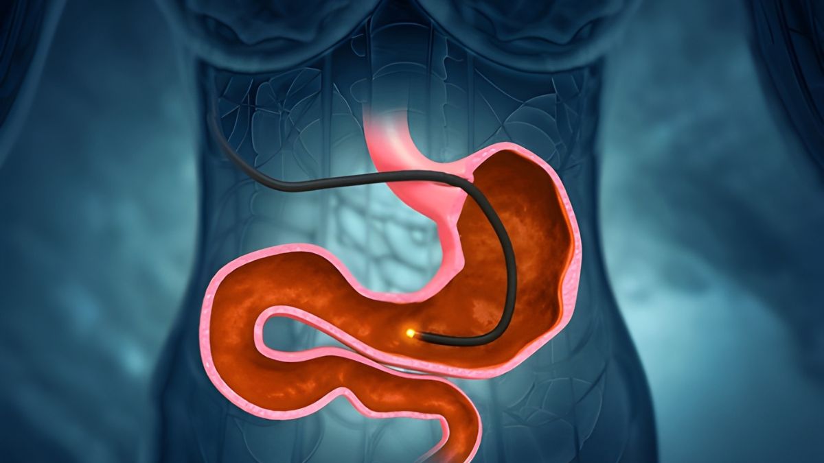 What exactly is an endoscopy