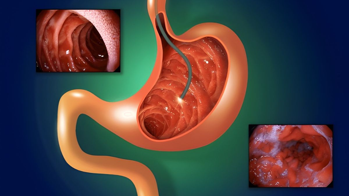 what happens during a colonoscopy