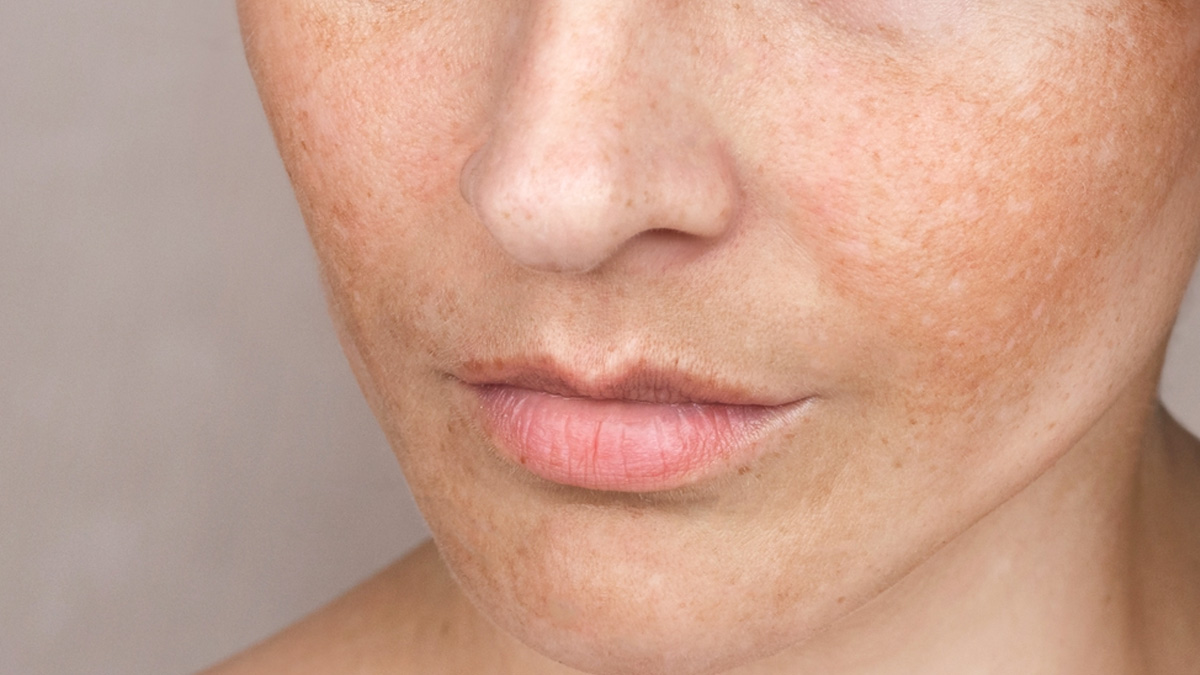 remedy for pigmentation