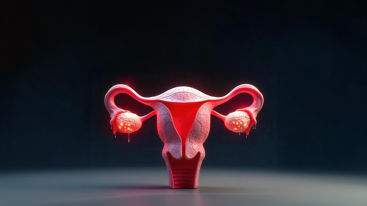 pcos different types symptoms and diet changes