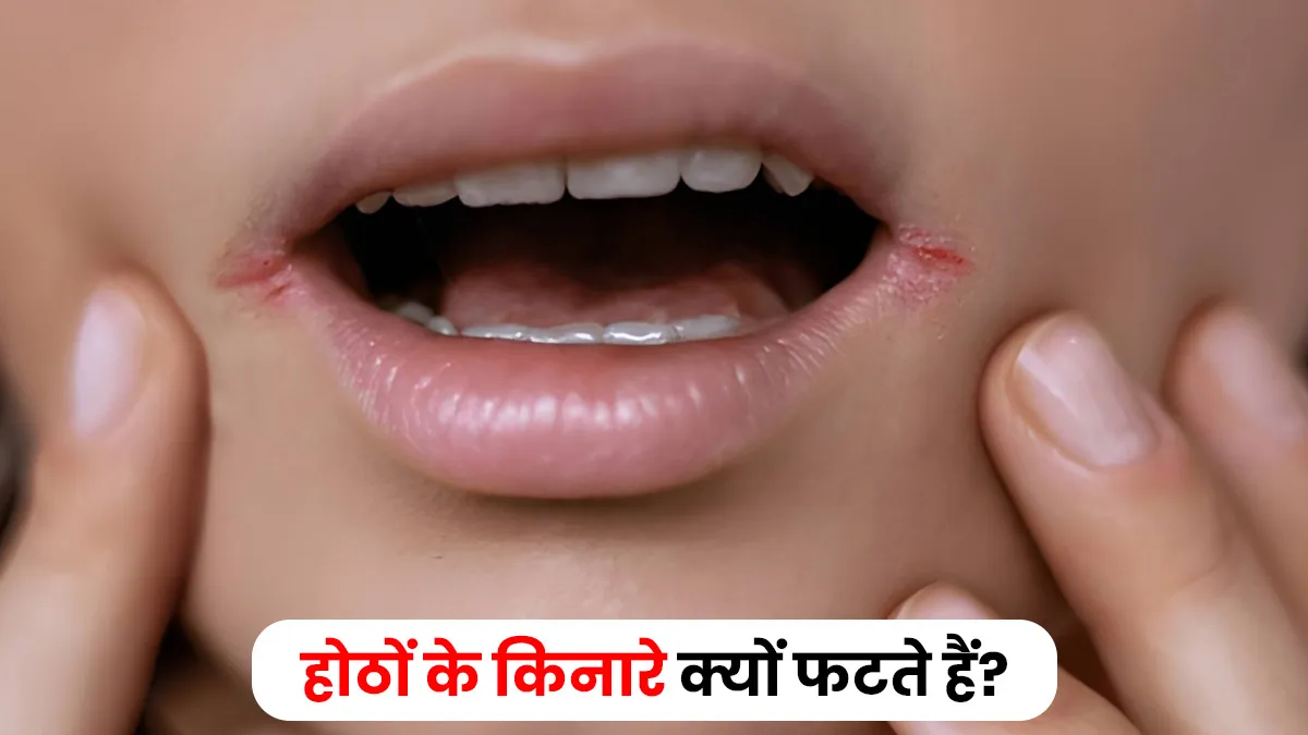 cracked lips corners reasons