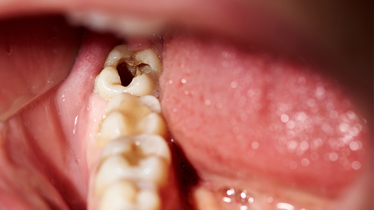 can kissing cause cavities or gum infection