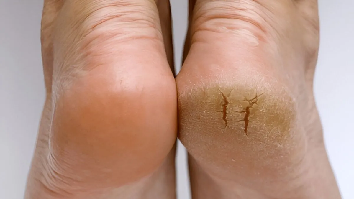 how-to-fix-cracked-heels-naturally-1754926078459
