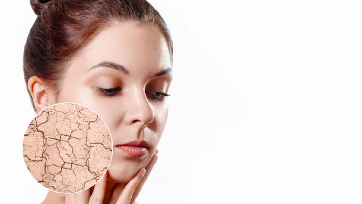 winter dry skin home remedies (1)