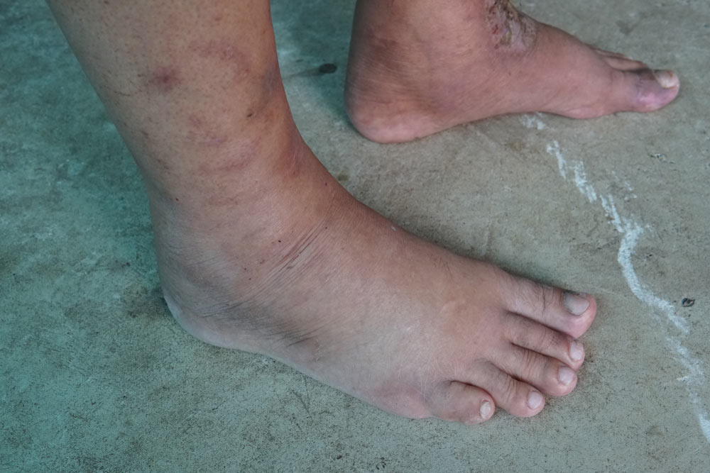 swelling sign of kidney damage