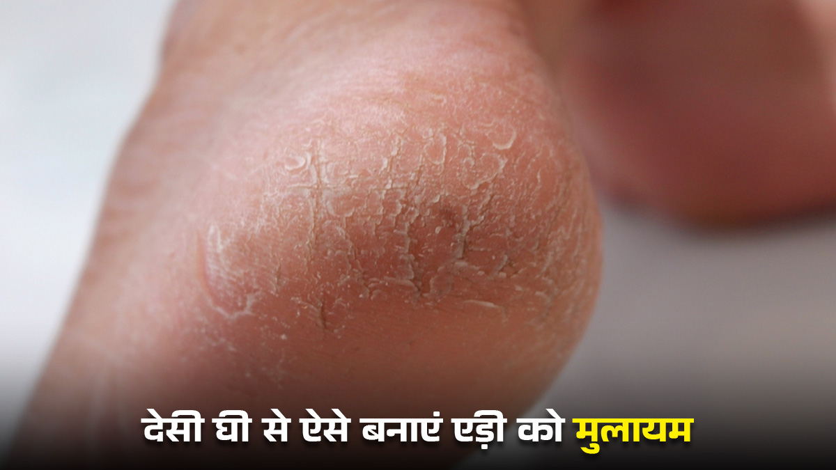 Cracked Heels Remedy: देसी घी का इस्तेमाल कर ऐसे बनाएं फटी एड़ी को मुलायम, जानें सही और आसान तरीका