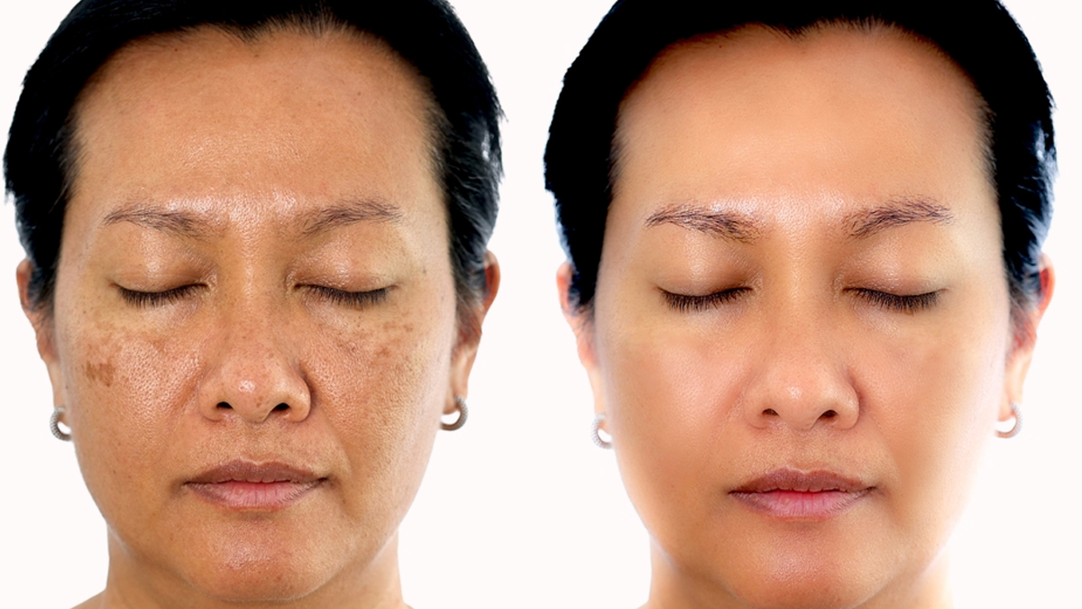 गालों के Black Spot कम करता है यह नुस्‍खा, एक्‍सपर्ट से जानें तरीका
