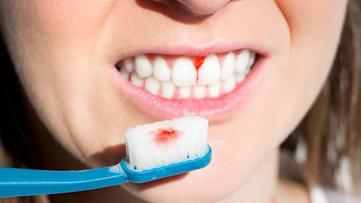 45 दिनों तक आंवला का ऐसे करें इस्‍तेमाल, मसूड़ों से खून आना होगा बंद