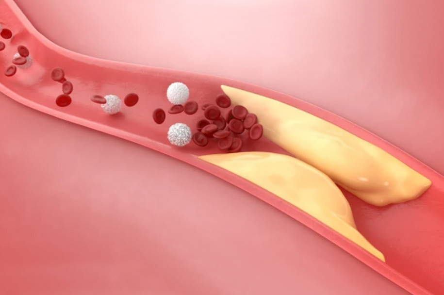 guava in winter for cholesterol