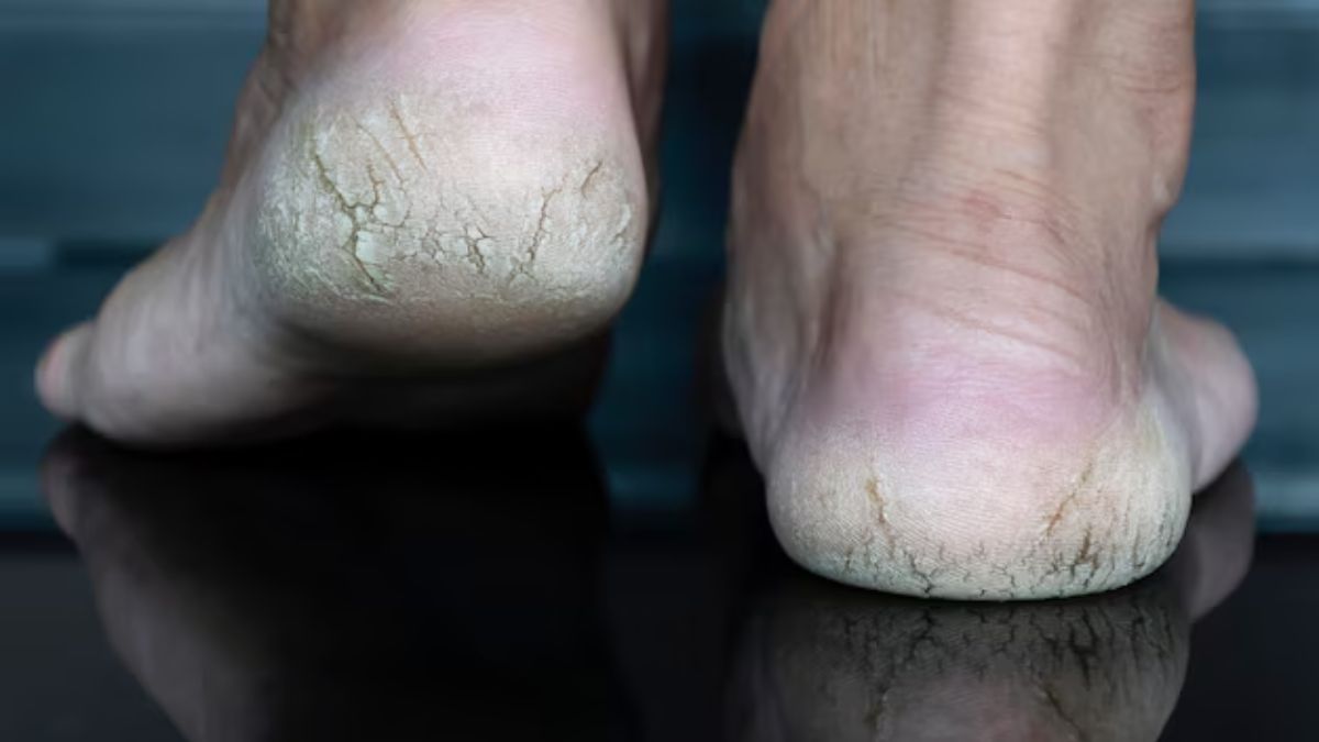 cracked heels treatment (1)