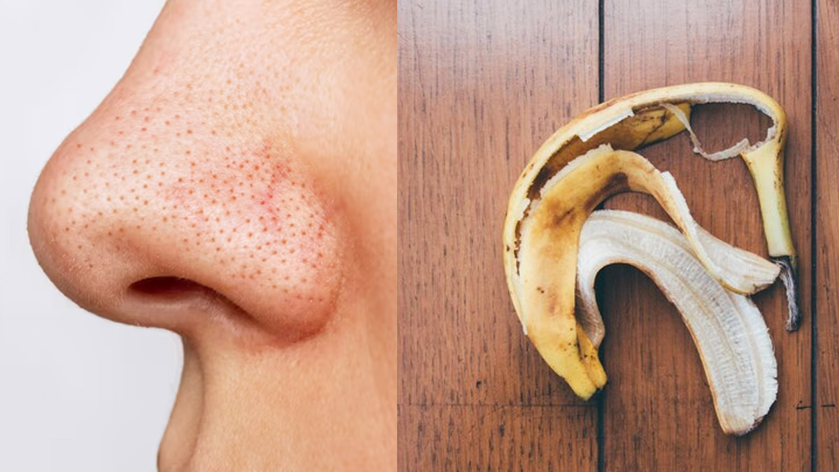 Blackheads Home Remedies: केले के छिलके का ऐसे करें इस्तेमाल, ब्लैकहेड्स से मिल सकती है राहत