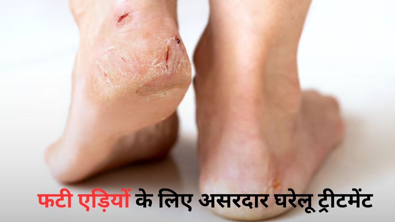Cracked Heels Treatment: सिर्फ 1 रात में भर जाएगी पैरों की फटी बिवाइयां, मैंने आजमाया अब आप भी करें ट्राई