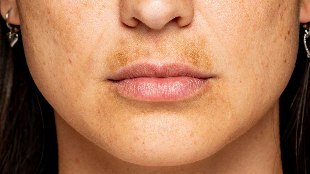 Pigmentation On Face