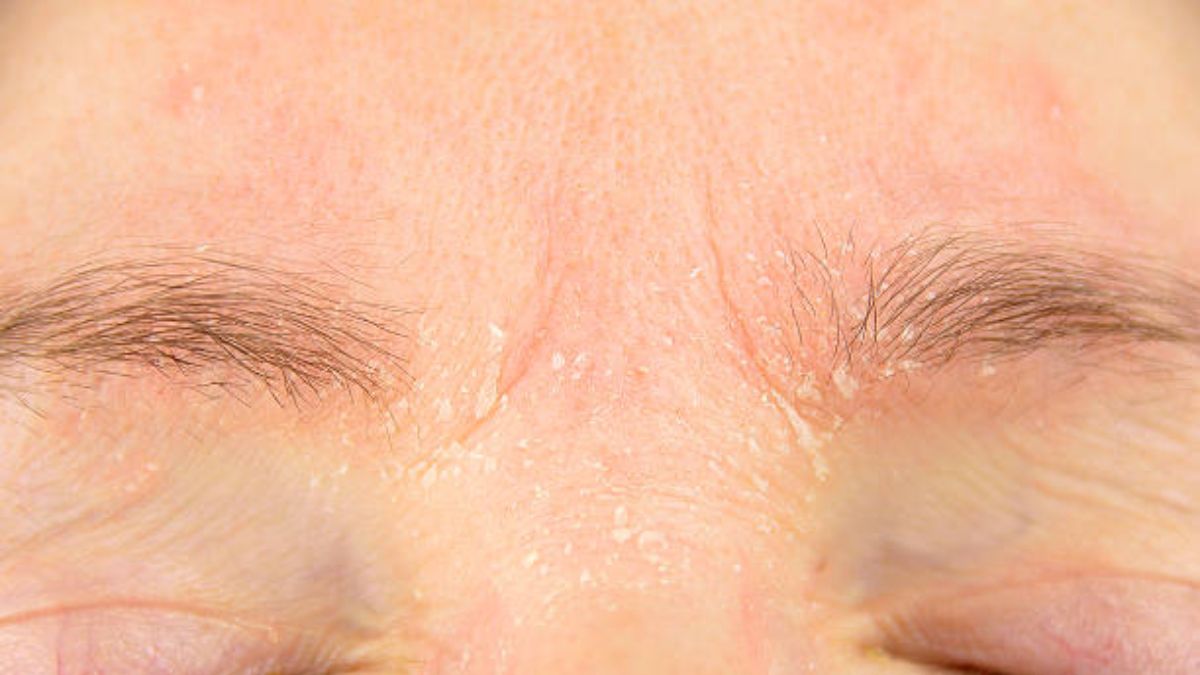 how to get rid of eyebrow dandruff (2)