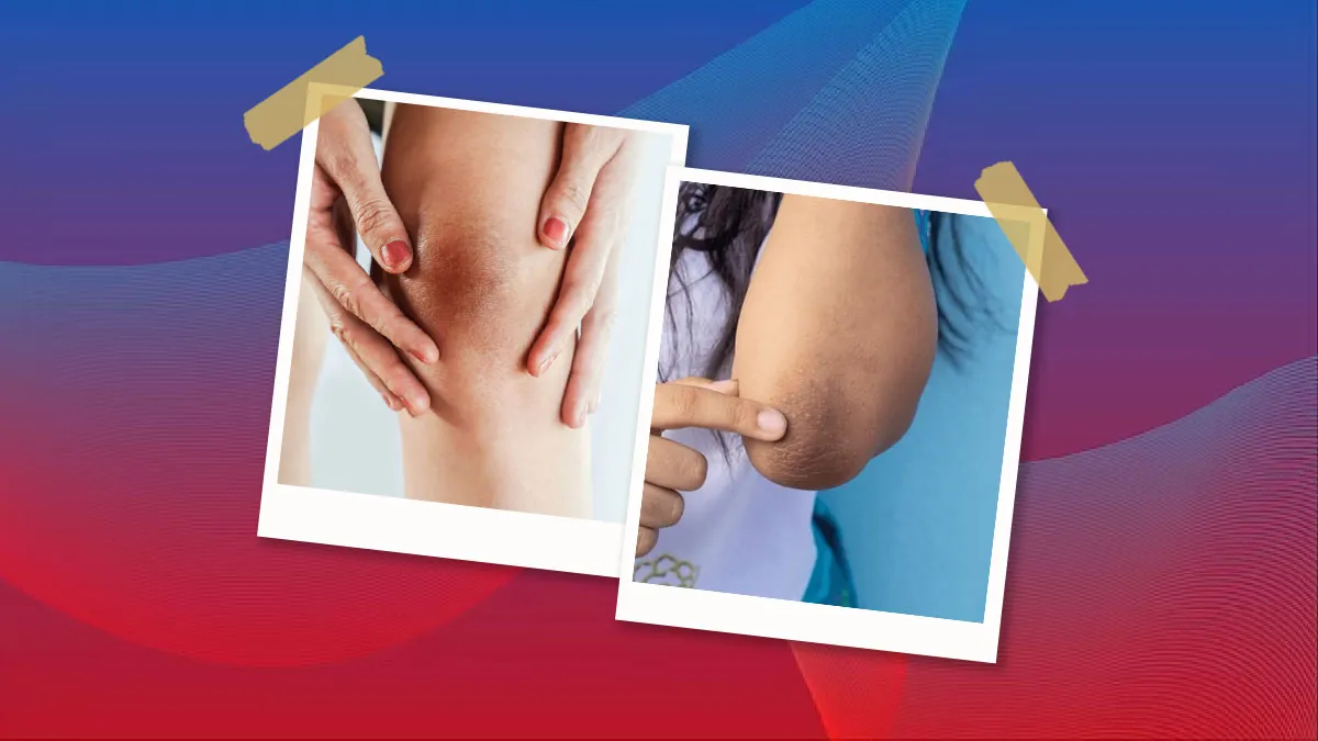 Dark-Knees-And-Elbows-Using-Kitchen-Ingredients