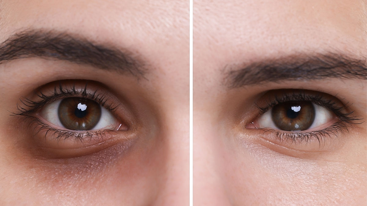 आंखों के नीचे आ गए हैं काले घेरे? इस जादुई सलाद को करें डाइट में शामिल और देखें कमाल