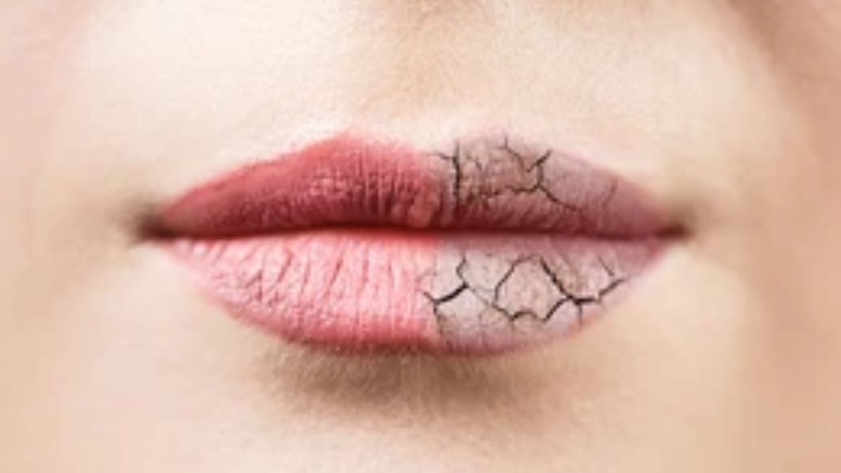 Lip Care Tips: बदलते मौसम में फटने लगे हैं होंठ, करें ये एक काम; रातों-रात हो जाएंगे सॉफ्ट