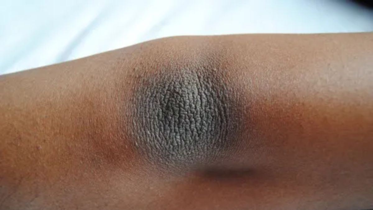 dark elbows remedy (1)