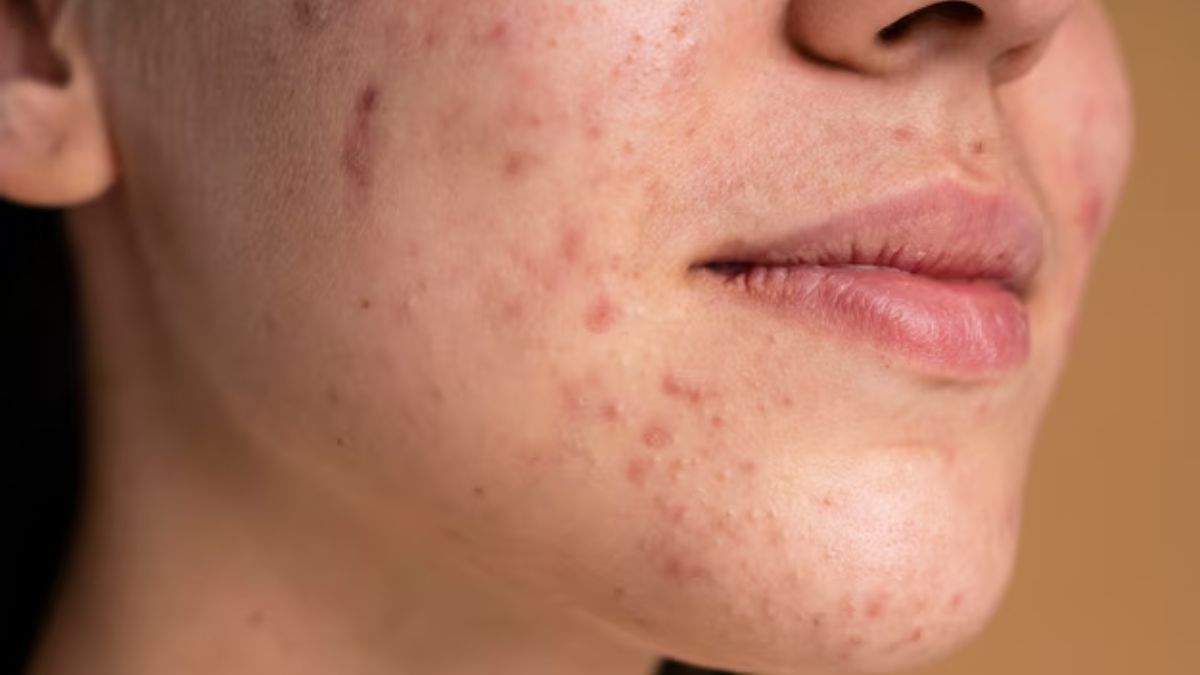 face mask for pimple marks and acne scars (1)