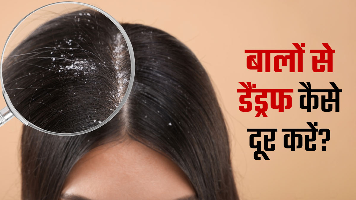 महंगे शैंपू छोड़िए, इस उपाय से सिर्फ 2 हफ्ते में गायब होगा Dandruff