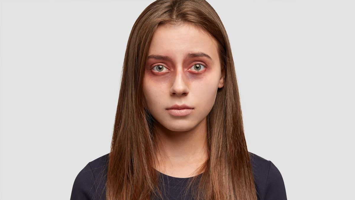 coconut oil to reduce dark circles