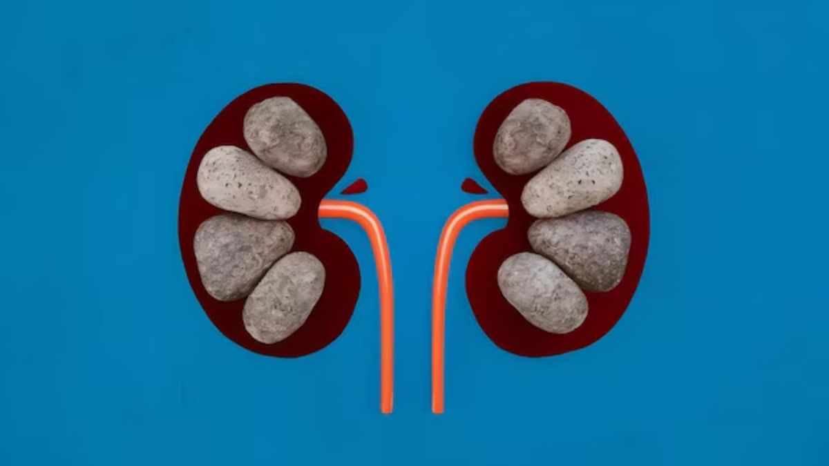 kidney stone risk (1)