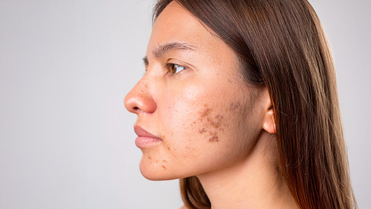 Pigmentation On Face: चेहरे की पिग्मेंटेशन हो सकती है कम, जब अपनाएंगी ये 2 असरदार घरेलू उपाय