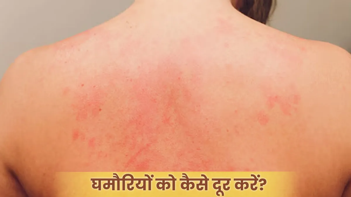 बाजार के पाउडर को कहें बाय-बाय, नीम से घर पर बनाएं घमौरी को दूर करने के ...