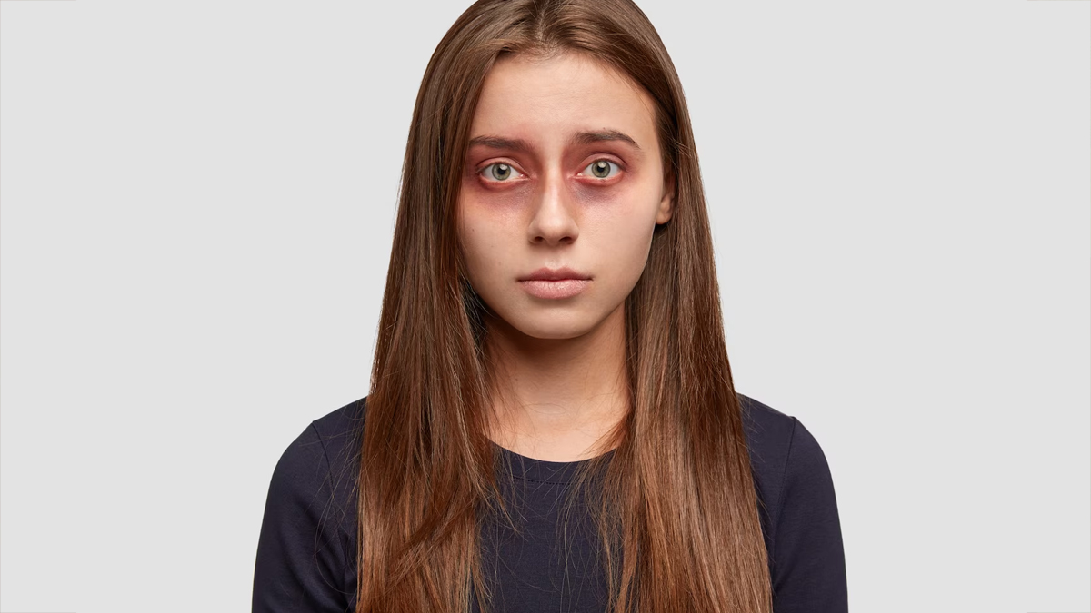 dark circles