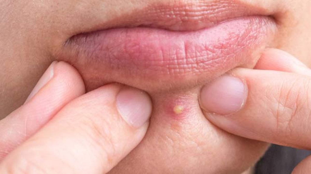 tips-to-get-rid-of-chin-acne