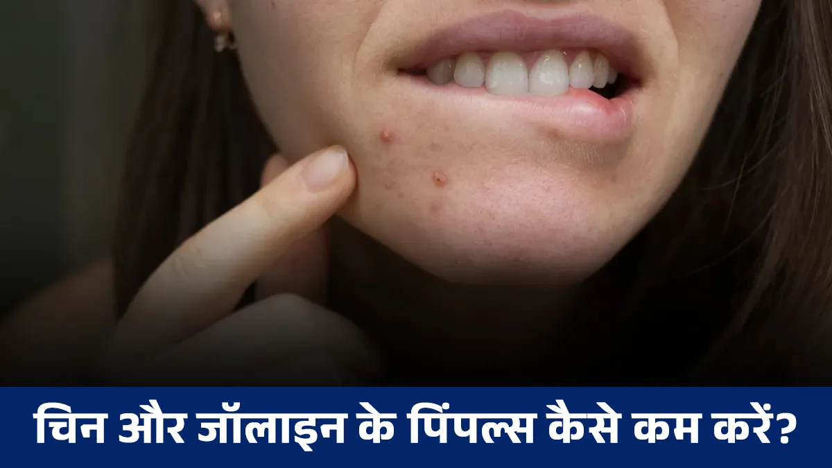 diy chandan and honey face pack for chin and jawline pimples