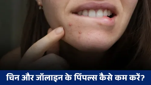 diy chandan and honey face pack for chin and jawline pimples