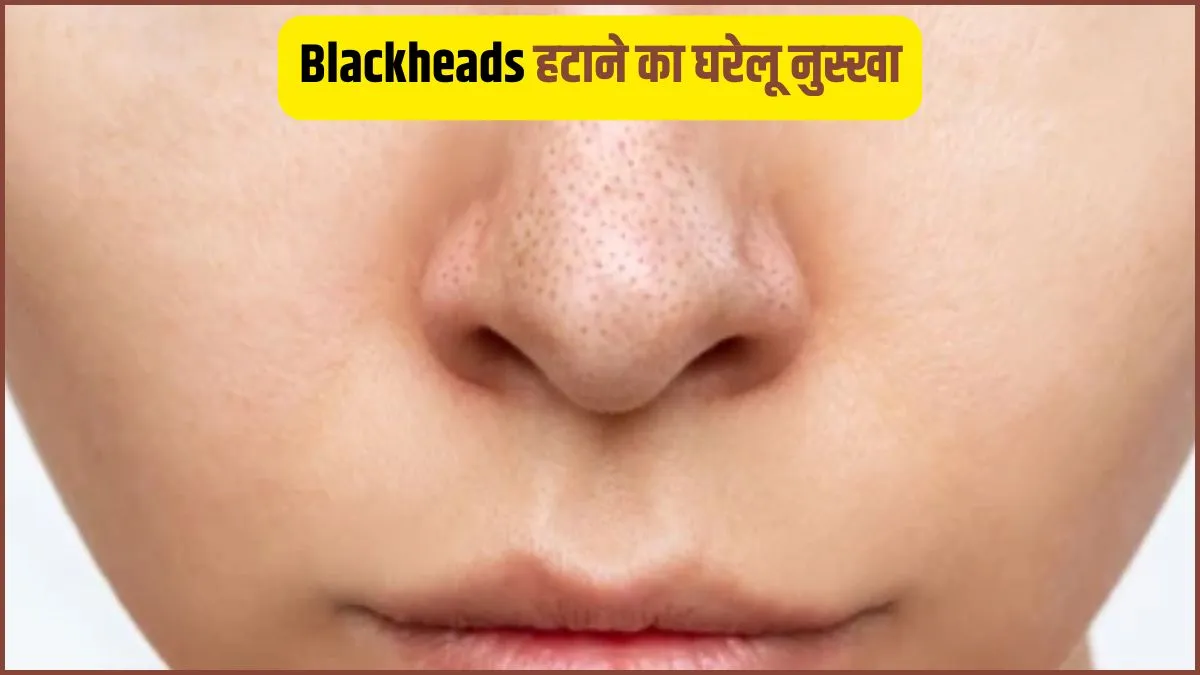 blackheads removal tips