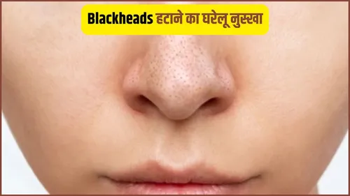 blackheads removal tips