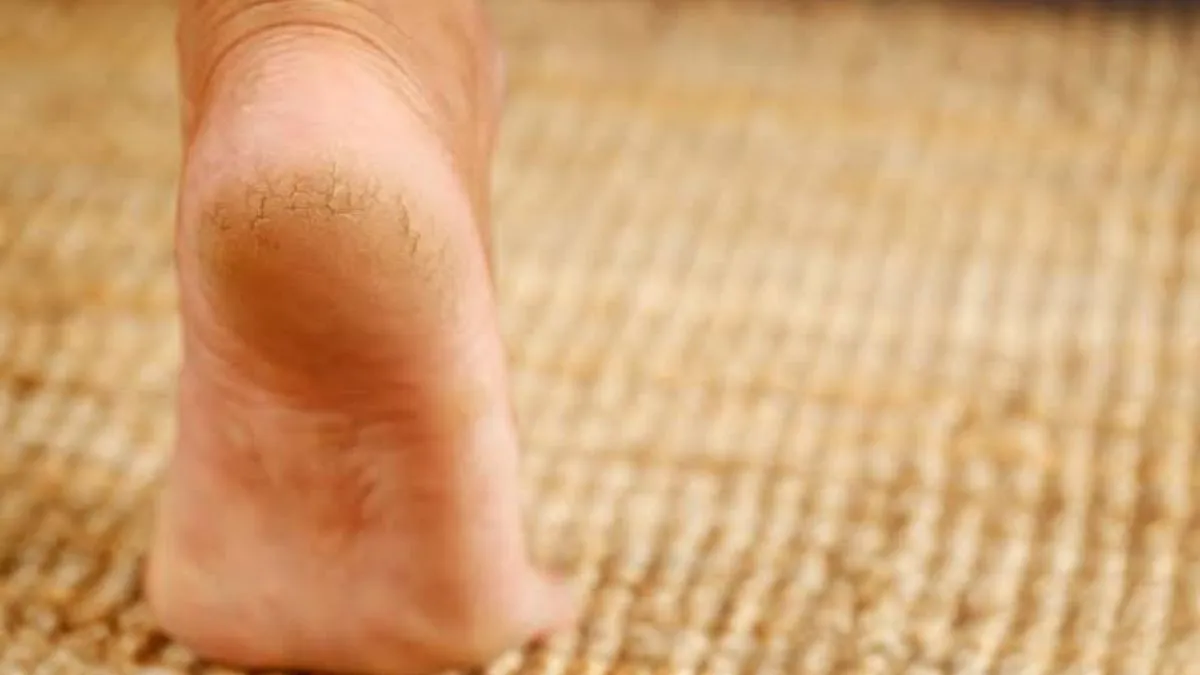 dry lips and cracked heels care (1)