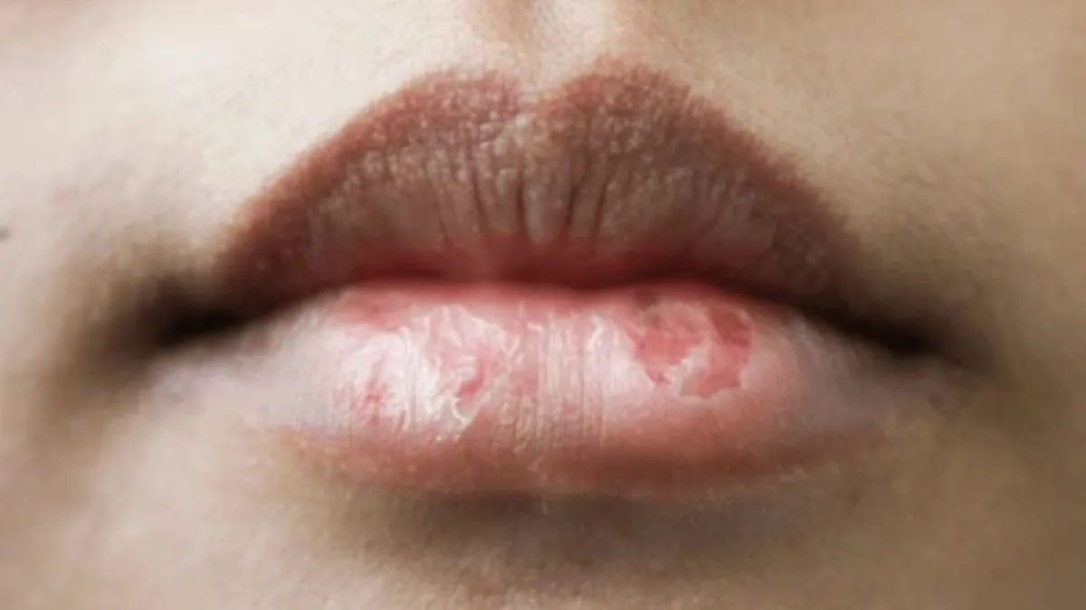 dry lips and cracked heels care (2)