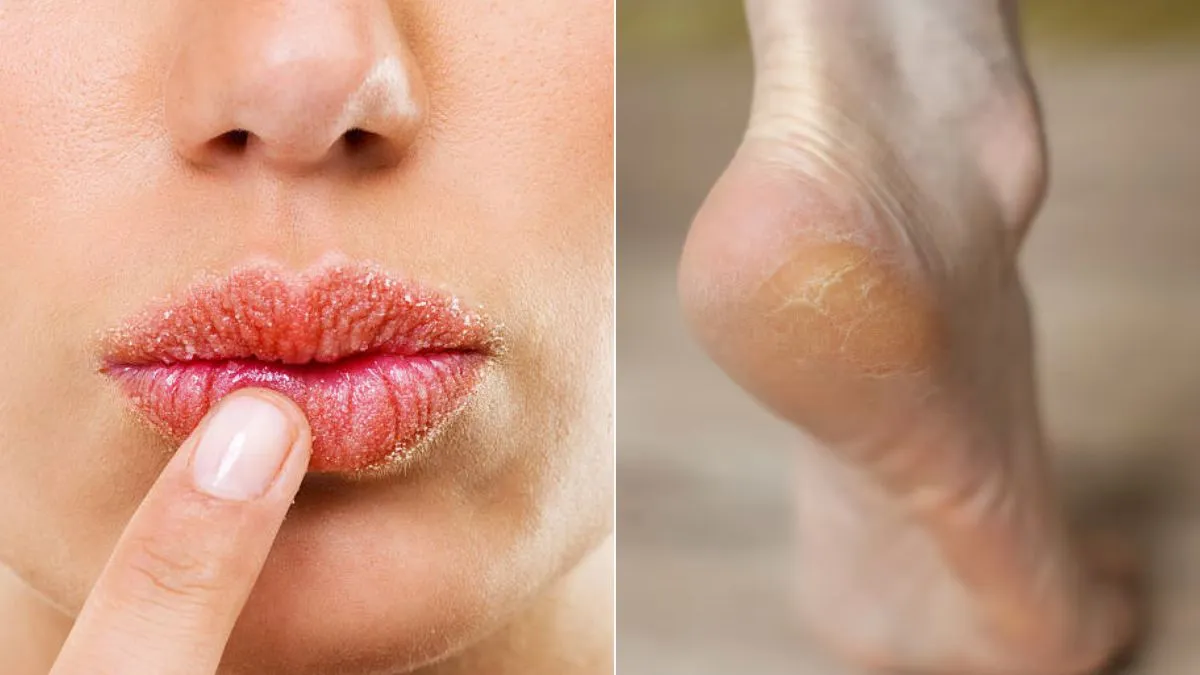 dry lips and cracked heels care