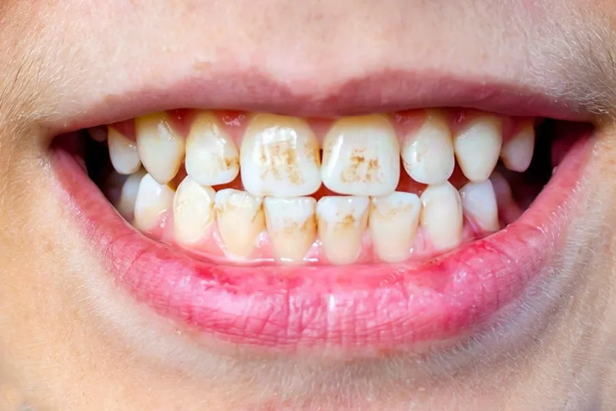 teeth yellowish reason