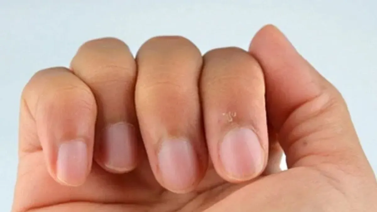 effective ways to treat peeling skin around nails (1)