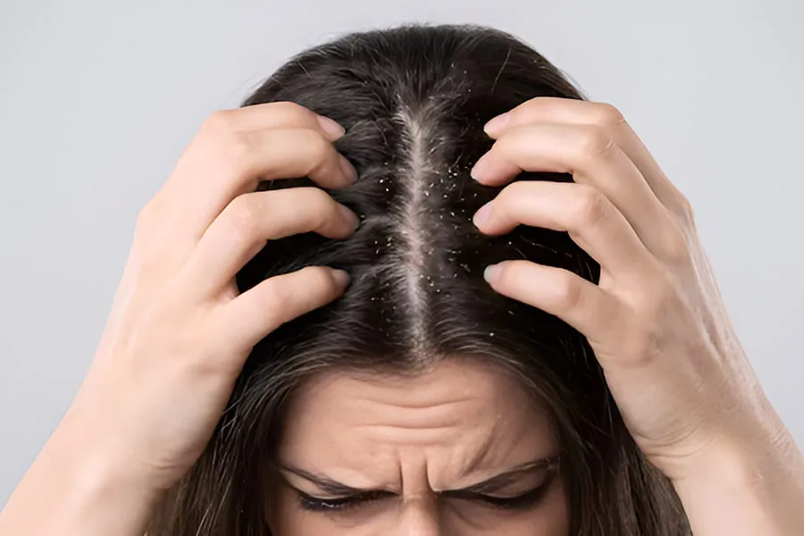 itching in hair
